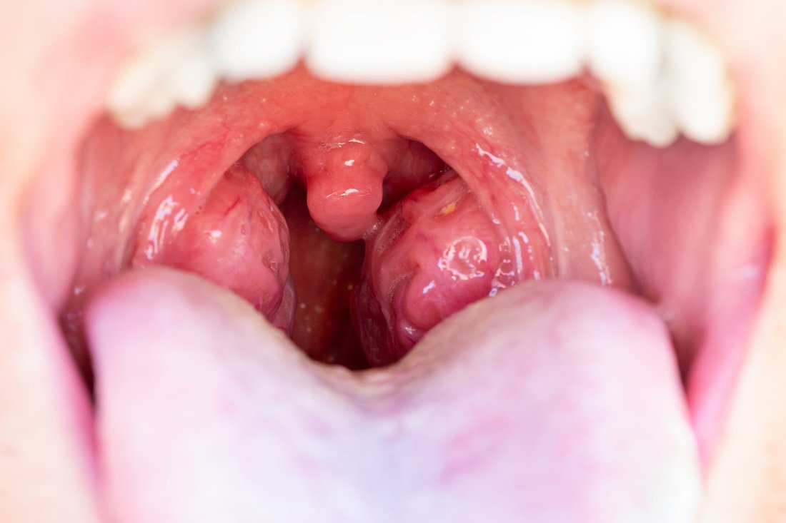 Effective Ways to Get Rid of Tonsil Stones in 2025: Discover Proven Remedies!