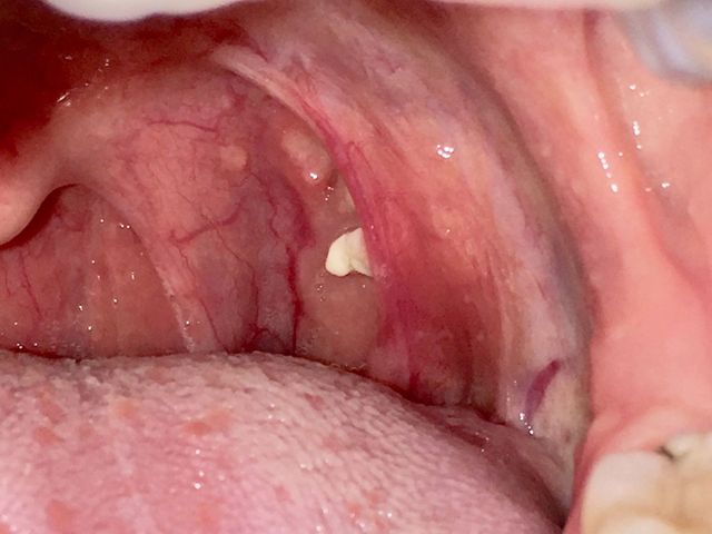 How to get rid of tonsil stones