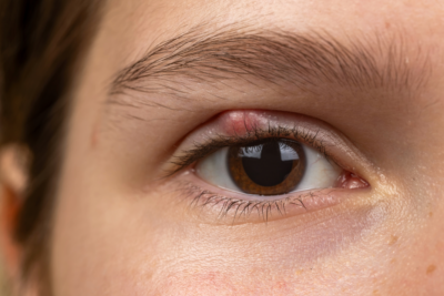 Effective Ways to Get Rid of a Stye Overnight: Discover Proven Remedies for 2025