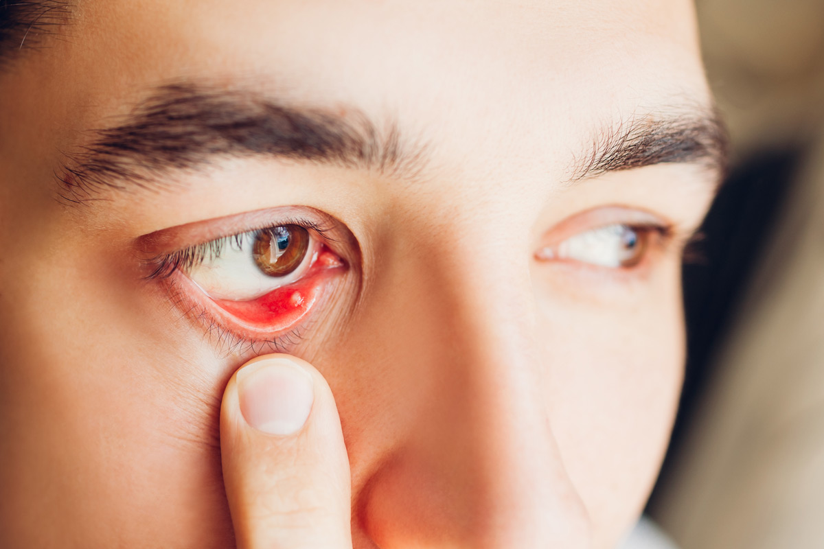 How to get rid of a stye overnight