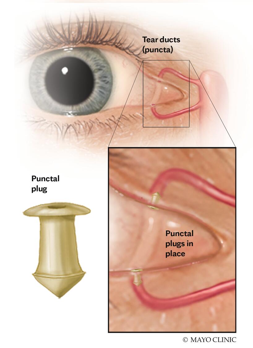 How to Effectively Cure Dry Eyes in 2025: Proven Methods for Lasting Relief