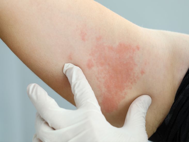 HIV Rash Example 2