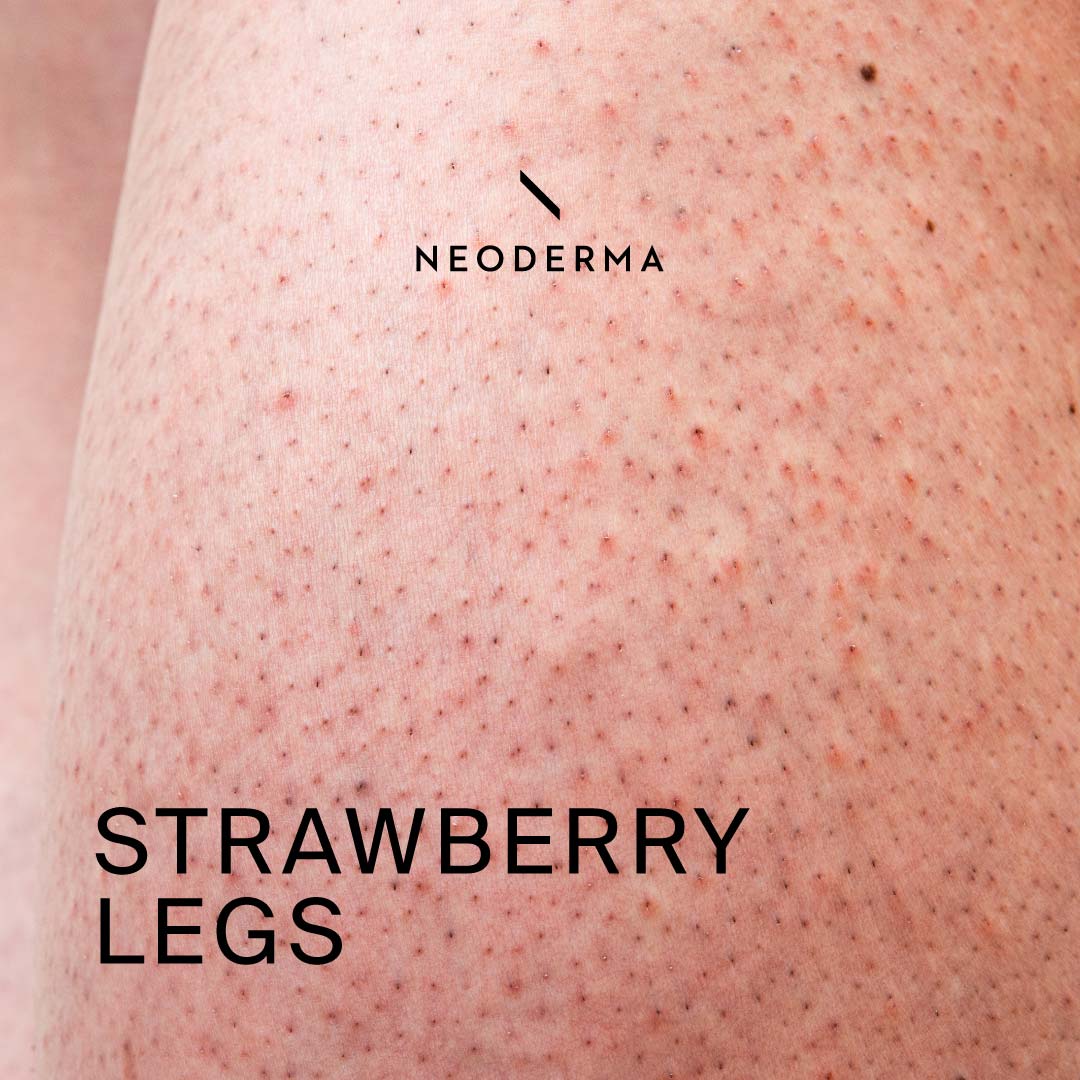 Effective Ways to Get Rid of Strawberry Legs: Practical Tips for Smooth Skin in 2025