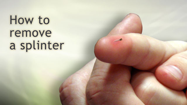 Effective Ways to Get a Splinter Out: Comprehensive Guide for 2025