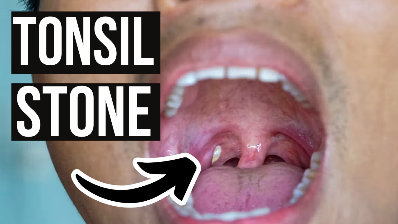 Effective Ways to Prevent Tonsil Stones: A Smart Guide for 2025